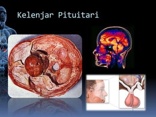 Kelenjar Pituitari
 