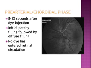  8-12 seconds after
dye injection
 Initial patchy
filling followed by
diffuse filling
 No dye has
entered retinal
circulation
 