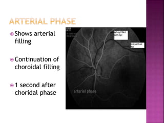  Shows arterial
filling
 Continuation of
choroidal filling
 1 second after
choridal phase
 