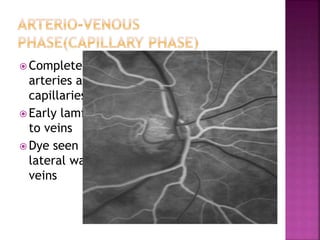  Complete filling of
arteries and
capillaries
 Early laminar flow
to veins
 Dye seen along
lateral wall of
veins
 