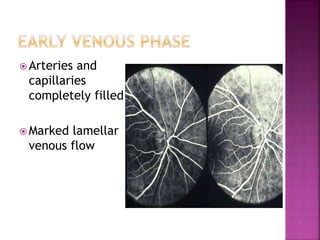  Arteries and
capillaries
completely filled
 Marked lamellar
venous flow
 
