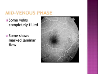  Some veins
completely filled
 Some shows
marked laminar
flow
 