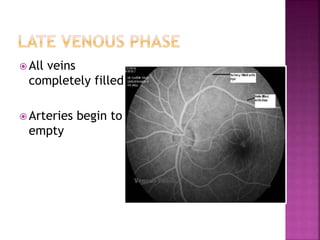  All veins
completely filled
 Arteries begin to
empty
 