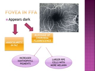  Appears dark
AVASCULARITY
IN FAZ
BLOCKAGE OF
CHOROIDAL
FLUORESCENCE
INCREASED
XANTHOPHYLL
PIGMENTS
LARGER RPE
CELLS WITH
MORE MELANIN
 