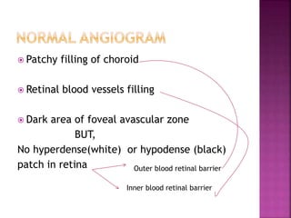  Patchy filling of choroid
 Retinal blood vessels filling
 Dark area of foveal avascular zone
BUT,
No hyperdense(white) or hypodense (black)
patch in retina Outer blood retinal barrier
Inner blood retinal barrier
 