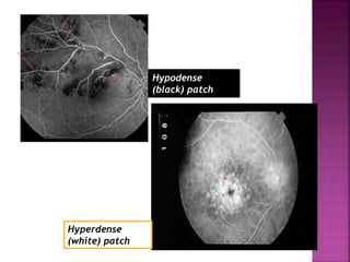 Hypodense
(black) patch
Hyperdense
(white) patch
 