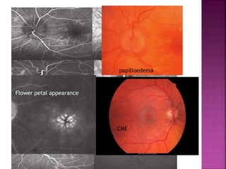 Flower petal appearance
CME
papilloedema
 