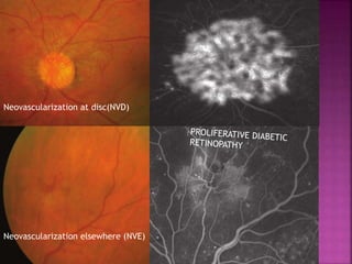Neovascularization at disc(NVD)
Neovascularization elsewhere (NVE)
 