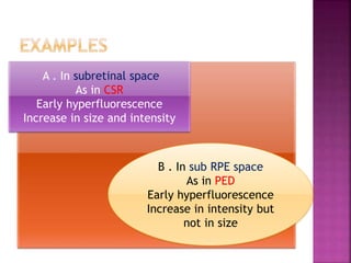 A . In subretinal space
As in CSR
Early hyperfluorescence
Increase in size and intensity
B . In sub RPE space
As in PED
Early hyperfluorescence
Increase in intensity but
not in size
 