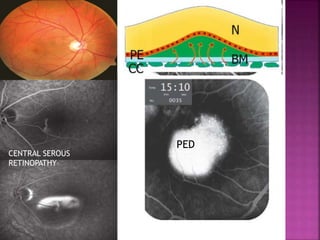 CENTRAL SEROUS
RETINOPATHY
PED
 