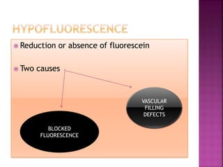  Reduction or absence of fluorescein
 Two causes
BLOCKED
FLUORESCENCE
VASCULAR
FILLING
DEFECTS
 