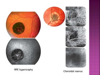 RPE hypertrophy
Choroidal naevus
 