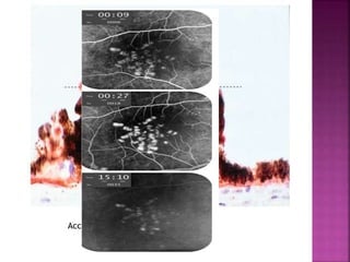 Accumulation of drusens under RPE
 