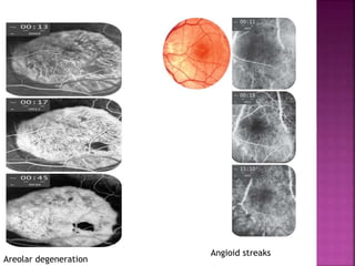 Angioid streaks
Areolar degeneration
 