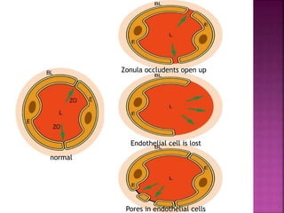 Zonula occludents open up
normal
Endothelial cell is lost
Pores in endothelial cells
 
