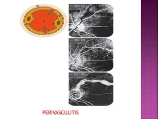 PERIVASCULITIS
 