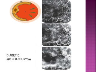 DIABETIC
MICROANEURYSM
 