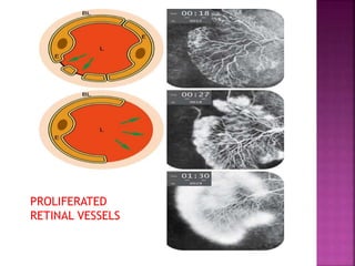 PROLIFERATED
RETINAL VESSELS
 
