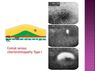 Cental serous
chorioretinopathy Type I
 