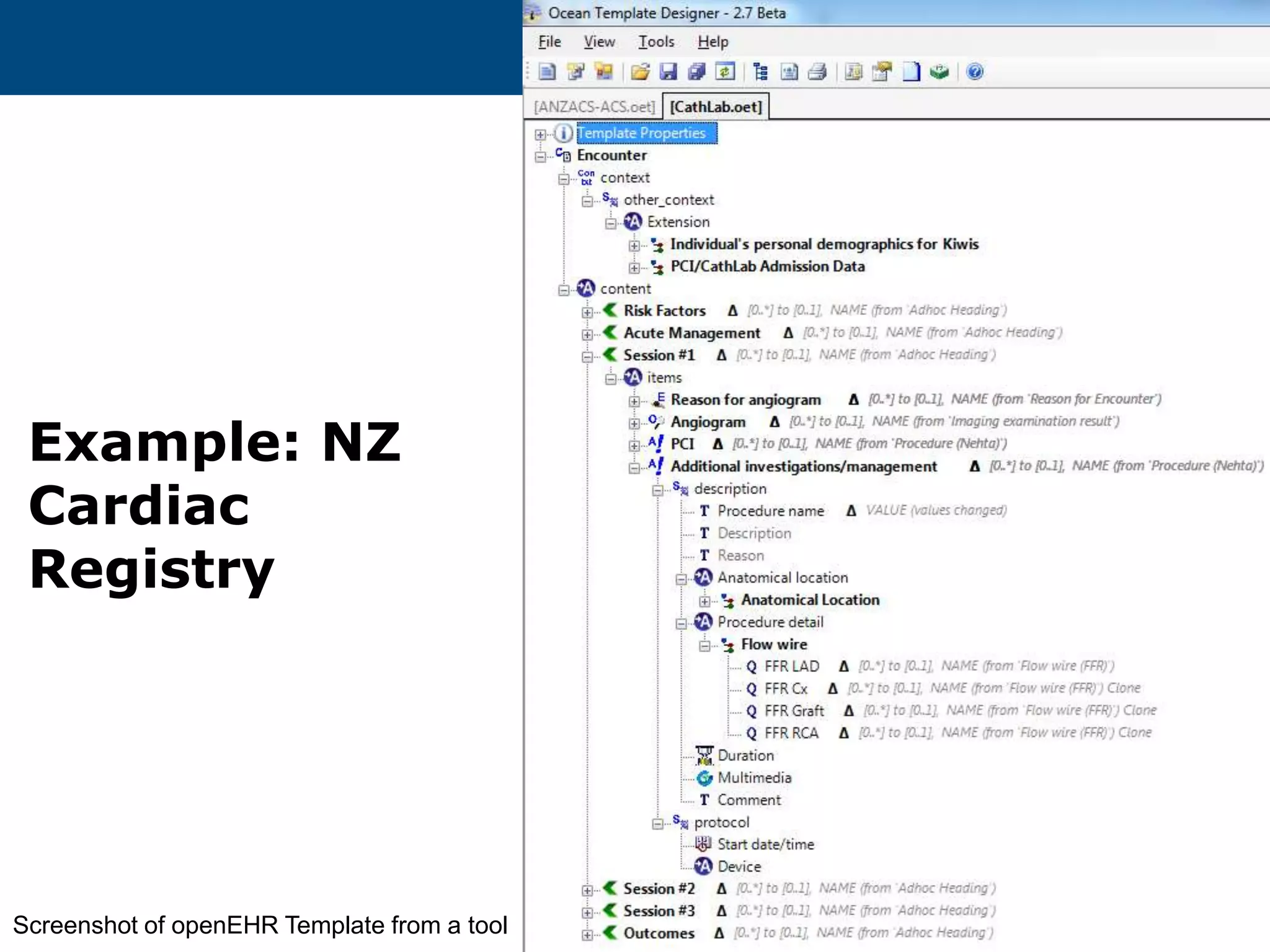 Example: NZ
Cardiac
Registry
14
Screenshot of openEHR Template from a tool
 