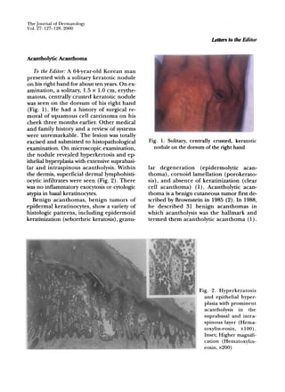 TheJournal of Dermatology
Vol. 27: 127-128,2000
Acantholytic Acanthoma
To the Editor: A 54-year-old Korean man
presented with a solitary keratotic nodule
on his right hand for about ten years. On ex-
amination, a solitary, 1.5 x 1.0 em, erythe-
matous, centrally crusted keratotic nodule
was seen on the dorsum of his right hand
(Fig. 1). He had a history of surgical re-
moval of squamous cell carcinoma on his
cheek three months earlier. Other medical
and family history and a review of systems
were unremarkable. The lesion was totally
excised and submitted to histopathological
examination. On microscopic examination,
the nodule revealed hyperkertosis and ep-
ithelial hyperplasia with extensive suprabasi-
lar and intraspinous acantholysis. Within
the dermis, superficial dermal lymphohisti-
.ocytic infiltrates were seen (Fig. 2). There
was no inflammatory exocytosis or cytologic
atypia in basal keratinocytes.
Benign acanthomas, benign tumors of
epidermal keratinocytes, show a variety of
histologic patterns, including epidermoid
keratinization (seborrheic keratosis), granu-
Letter:s to the Editor
Fig. 1. Solitary, centrally crusted, keratotic
nodule on the dorsum of the right hand
lar degeneration (epidermolytic acan-
thoma), cornoid lamellation (porokerato-
sis), and absence of keratinization (clear
cell acanthoma) (1). Acantholytic acan-
thoma is a benign cutaneous tumor first de-
scribed by Brownstein in 1985 (2). In 1988,
he described 31 benign acanthomas in
which acantholysis was the hallmark and
termed them acantholytic acanthoma (1).
Fig. 2. Hyperkeratosis
and epithelial hyper-
plasia with prominent
acantholysis in the
suprabasal and intra-
spinous layer (Hema-
toxylin-eosin, xlOO).
Inset; Higher magnifi-
cation (Hematoxylin-
eosin, x200)
 