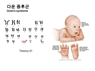 게놈 관련 연구의 대상물유전형질（trait）유전자형으로 인해 발생하는 결과의 공간질적형질（qualitative trait）양적형질（quantitative trait）발병비발병2.16.49.7병의 발병유무검사치표현형（phenotype）