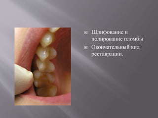  Шлифование и
полирование пломбы
 Окончательный вид
реставрации.
 