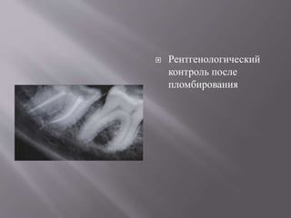  Рентгенологический
контроль после
пломбирования
 