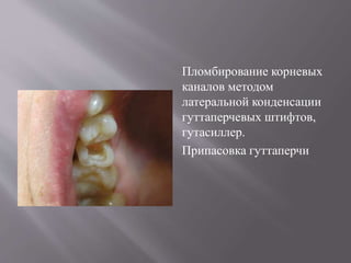 Пломбирование корневых
каналов методом
латеральной конденсации
гуттаперчевых штифтов,
гутасиллер.
Припасовка гуттаперчи
 