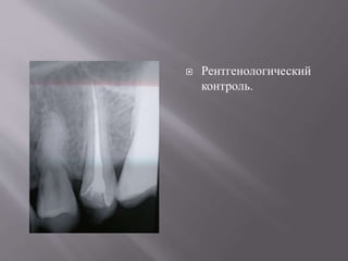  Рентгенологический
контроль.
 