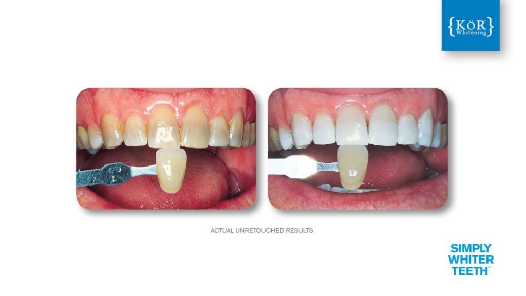 KoR Whitening Best Teeth Whitening in Long Island