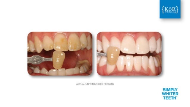 KoR Whitening Best Teeth Whitening in Long Island