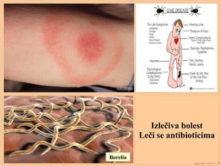Borelia
Izlečiva bolest
Leči se antibioticima
 