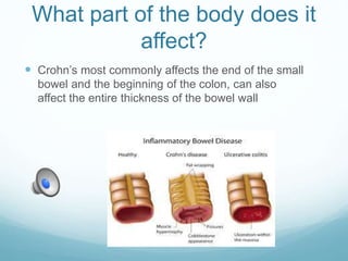 What part of the body does it
affect?
 Crohn’s most commonly affects the end of the small
bowel and the beginning of the colon, can also
affect the entire thickness of the bowel wall
 