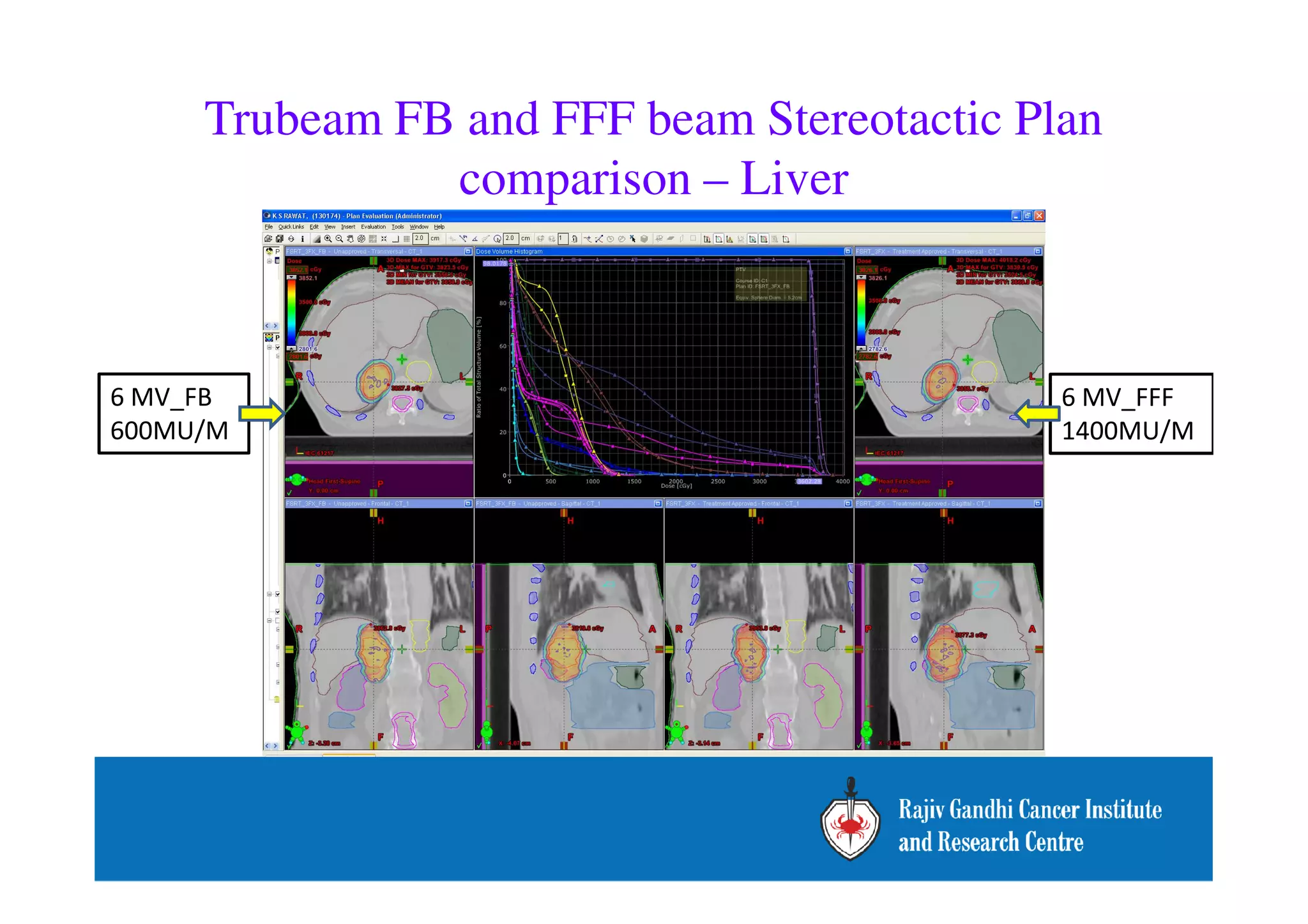 Trubeam FB and FFF beam Stereotactic Plan 
comparison – Liver 
6 MV_FFF 
1400MU/M 
6 MV_FB 
600MU/M 
 