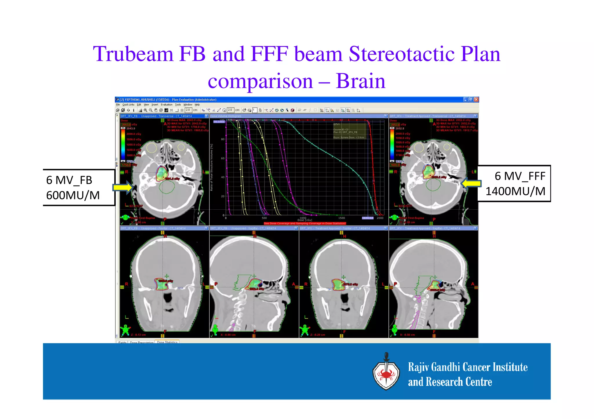 Trubeam FB and FFF beam Stereotactic Plan 
comparison – Brain 
6 MV_FB 
600MU/M 
6 MV_FFF 
1400MU/M 
 