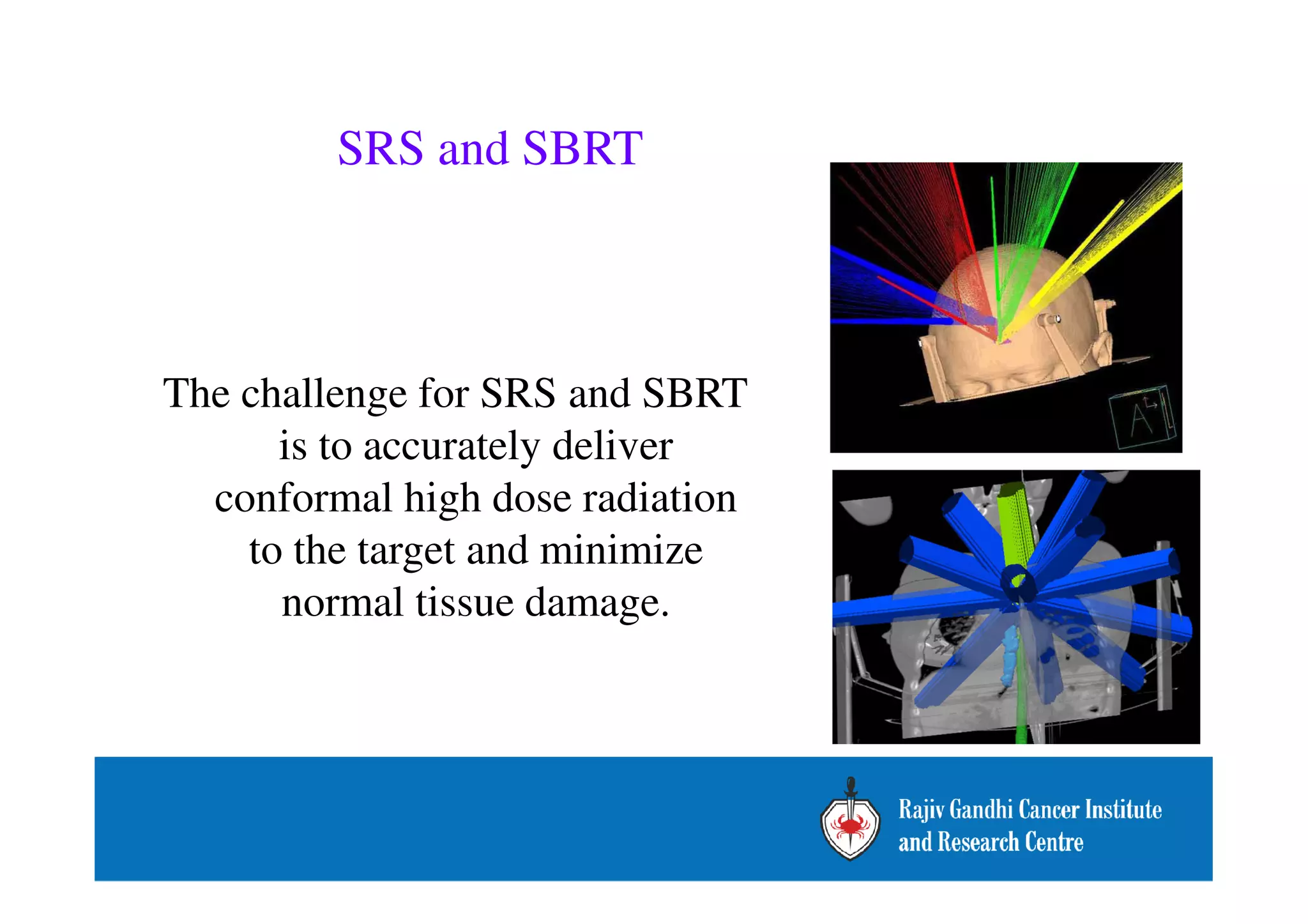 SRS and SBRT 
The challenge for SRS and SBRT 
is to accurately deliver 
conformal high dose radiation 
to the target and minimize 
normal tissue damage. 
 
