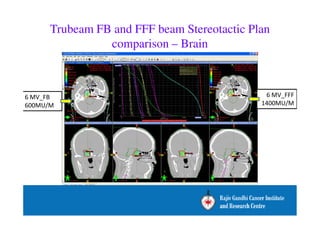 Trubeam FB and FFF beam Stereotactic Plan 
comparison – Brain 
6 MV_FB 
600MU/M 
6 MV_FFF 
1400MU/M 
 