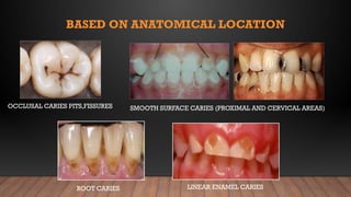 Koushigan DC.pptx regarding dental caries | PPTX