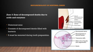fundamental concepts of Dental caries.pptx