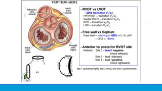 Vt Localization Guide ECG -Ventricular tachycardia localisation .pptx