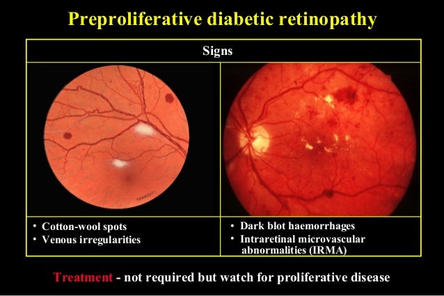 49 diabetic retinopathy