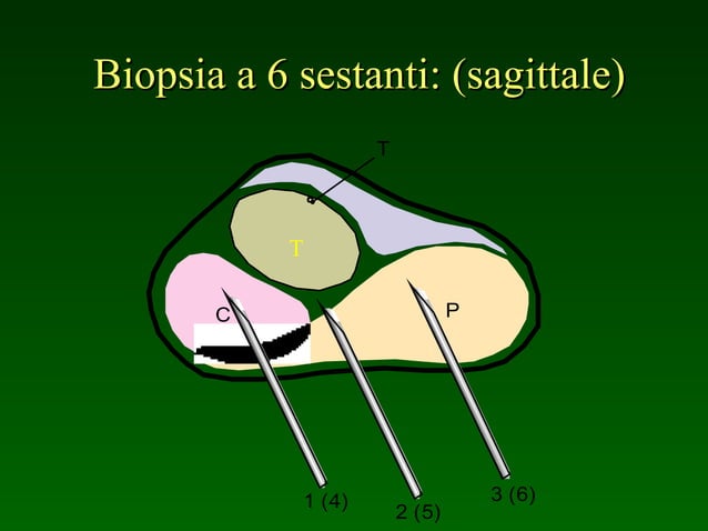 LA NEOPLASIA DELLA PROSTATA Diagnosi Stadiazione E Screening PPT la-neoplasia-della-prostata-diagnosi-stadiazione-e-screening-ppt