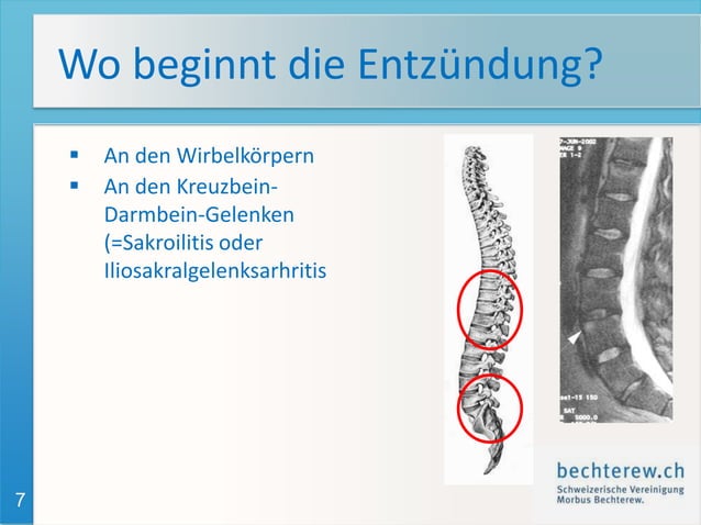 Krankheitsbild Morbus Bechterew