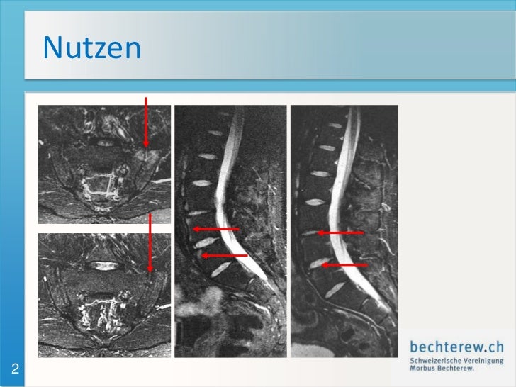 Krankheitsbild Morbus Bechterew