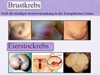 Brustkrebs
Stellt die häufigste Krebserkrankung in der Europäischen Union.
Eierstockrebs
 