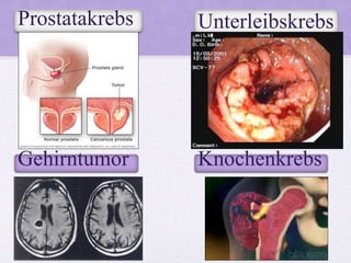 Prostatakrebs
Gehirntumor
Unterleibskrebs
Knochenkrebs
 