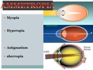  Myopia
 Hyperopia
 Astigmatism
 aberropia
 