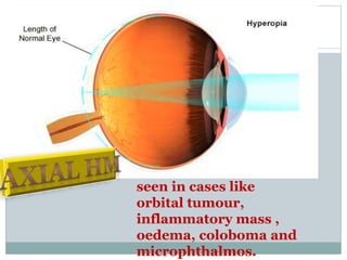 seen in cases like
orbital tumour,
inflammatory mass ,
oedema, coloboma and
microphthalmos.
 