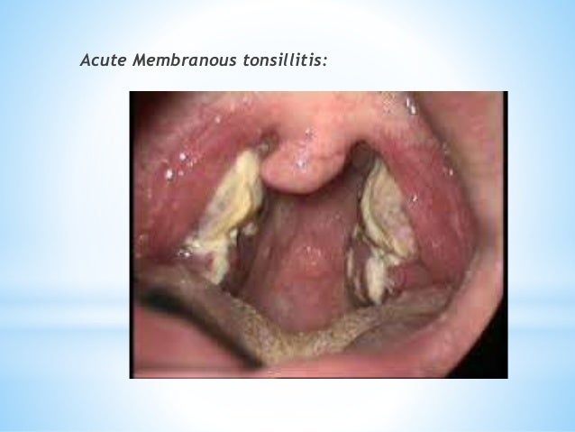 acute sensitivity to noise in adults acute sensitivity to noise in adults